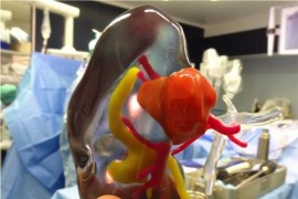 法国医院将3D打印彩色模型用于肾肿瘤切除手术（图文教程）